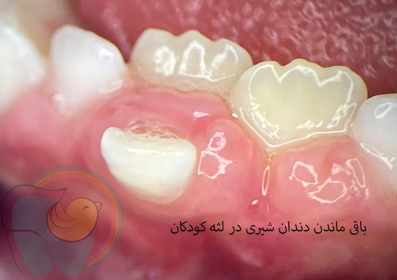باقی ماندن دندان شیری در لثه کودکان