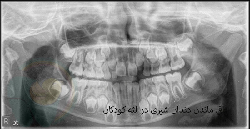 باقی ماندن دندان شیری در لثه کودکان