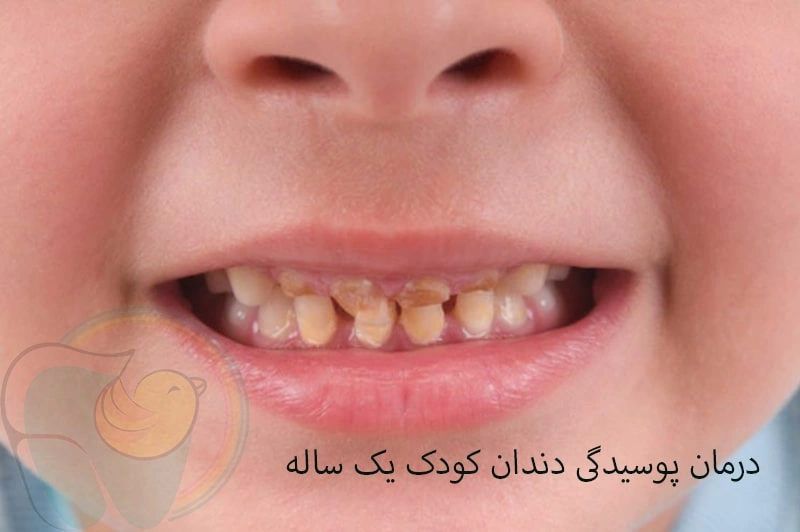 درمان پوسیدگی دندان کودک یک‌ ساله
