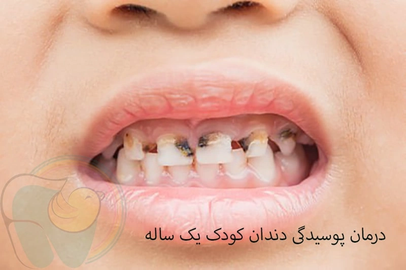 درمان پوسیدگی دندان کودک یک‌ ساله