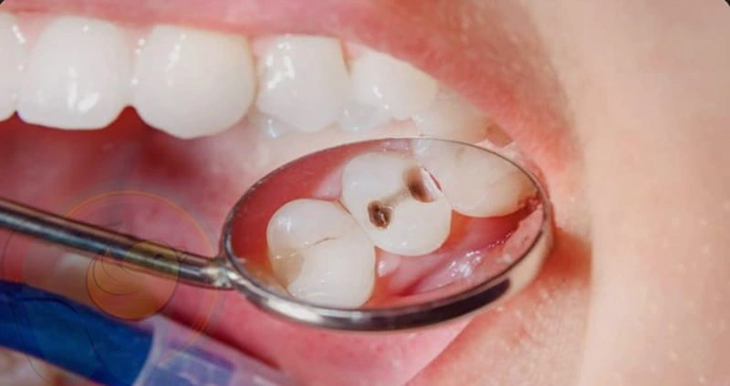 علت سوراخ شدن دندان کودکان چیست؟