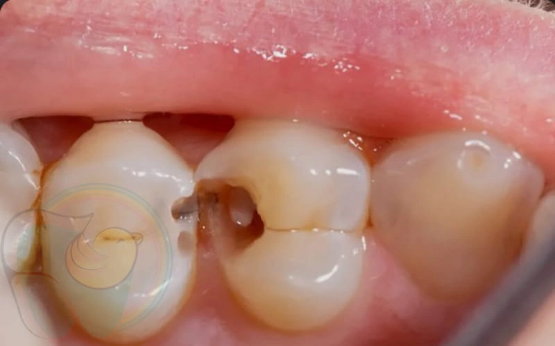 علت سوراخ شدن دندان کودکان چیست؟