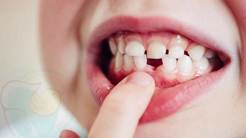 زمان افتادن دندان کودکان