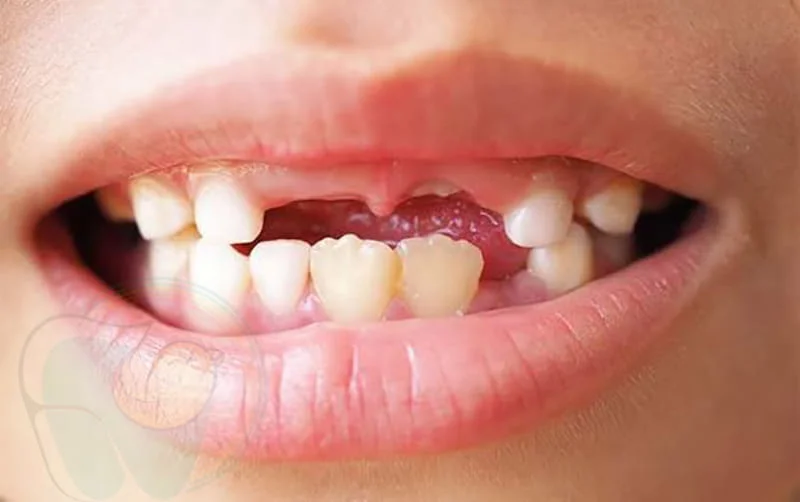 چگونه بفهمیم دندان شیری است؟ تفاوت دندان شیری و دائمی