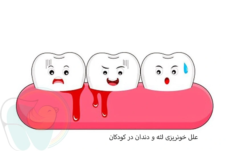 علل خونریزی لثه و دندان در کودکان چیست؟
