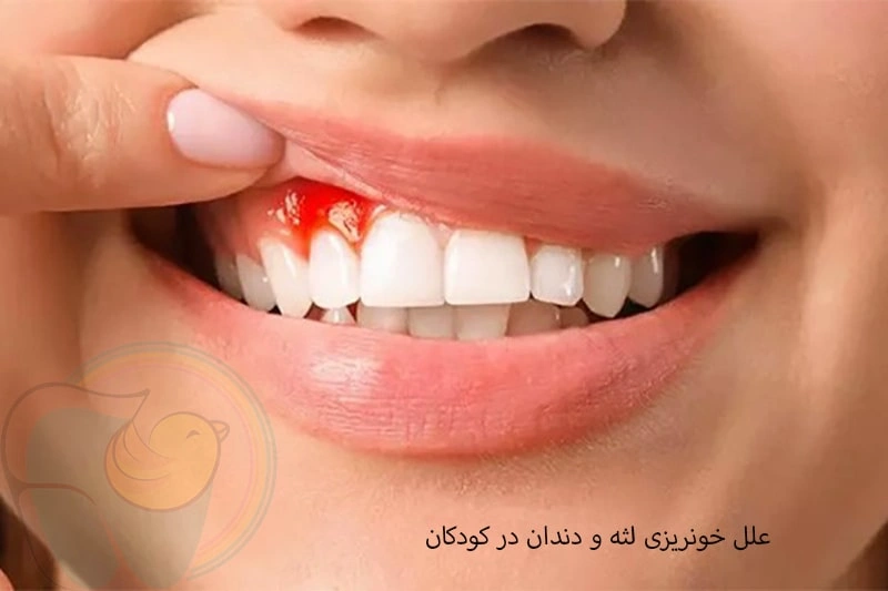 علل خونریزی لثه و دندان در کودکان چیست؟