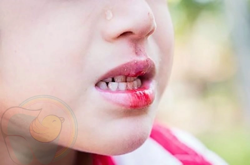 شکستن دندان جلوی کودک را چطوری درمان کنیم؟