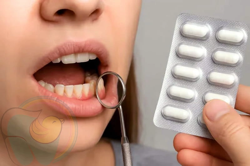 بهترین آنتی‌ بیوتیک برای عفونت لثه کودک چیست؟