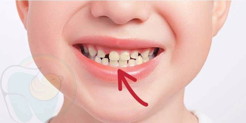 تغییر رنگ دندان شیری کودک به چه علتی است؟