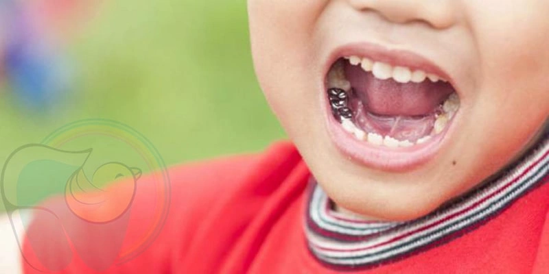 لق شدن روکش دندان شیری چطور اتفاق می افتد؟