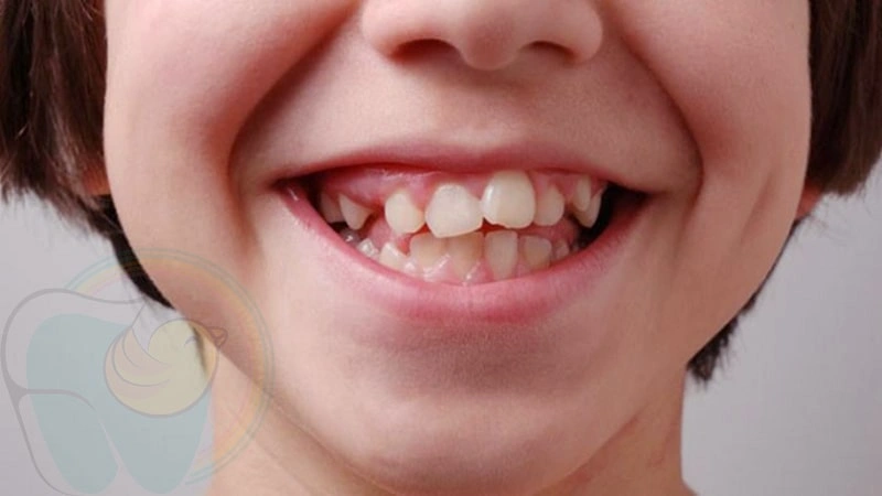 علت و راه های پیشگیری از کجی دندان ها در کودکان چیست؟