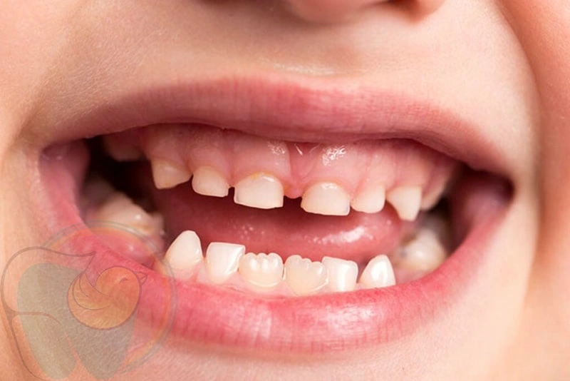 علت و راه های پیشگیری از کجی دندان ها در کودکان چیست؟