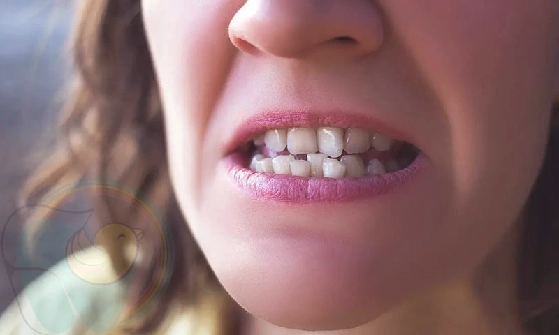 علت و راه های پیشگیری از کجی دندان ها در کودکان چیست؟