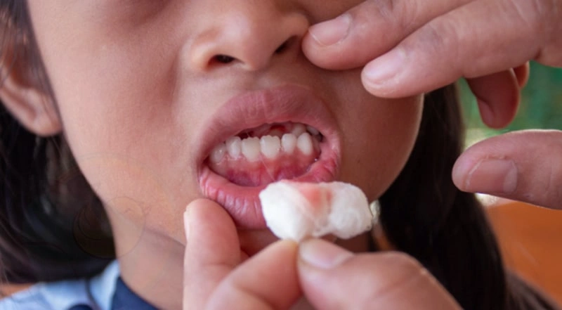 درمان کیست دندان کودکان در تهران
