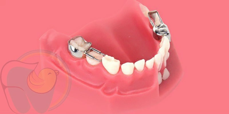فضا نگهدارنده دندان کودک چیست؟