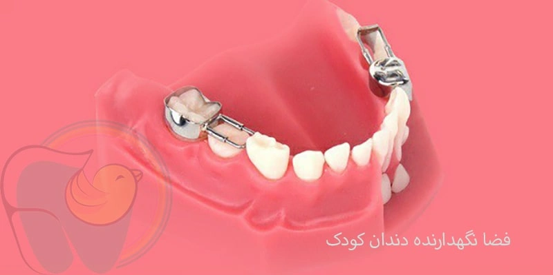 فضا نگهدارنده دندان کودک چیست؟