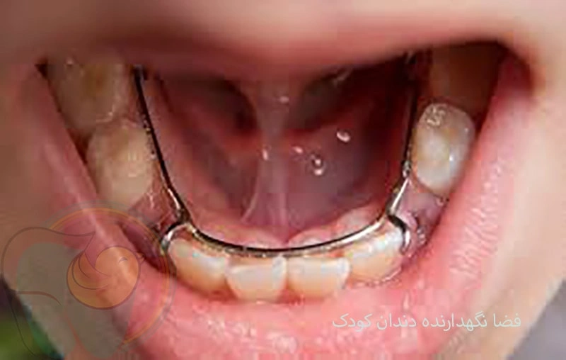 فضا نگهدارنده دندان کودک چیست؟