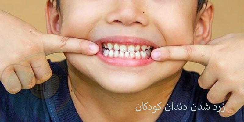 علت زرد و نارنجی شدن دندان شیری و دائمی کودکان چیست؟