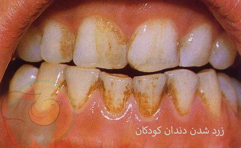 علت زرد و نارنجی شدن دندان کودکان چیست؟