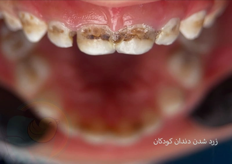 علت زرد و نارنجی شدن دندان کودکان چیست؟
