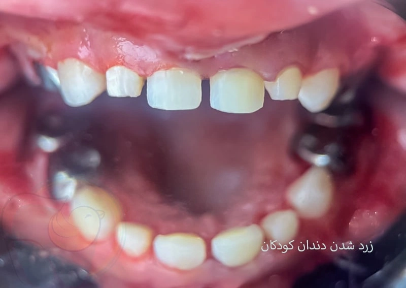 علت زرد و نارنجی شدن دندان کودکان چیست؟