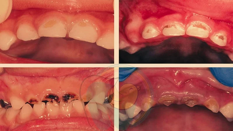درمان پوسیدگی دندان کودکان